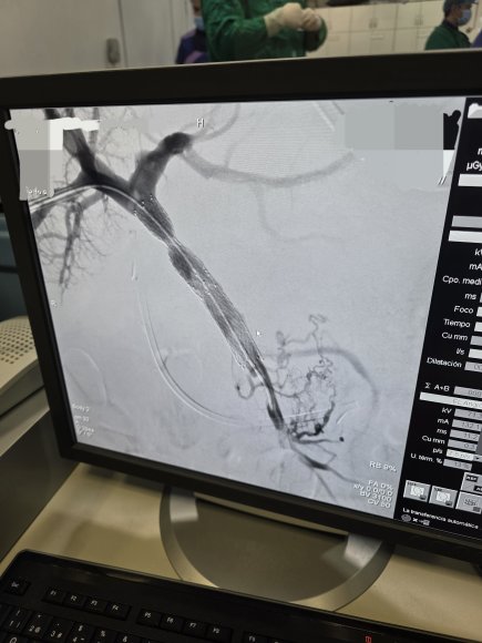 Estenosis de la vena porta tratada con un stent 