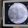 Cateterismo cardiaco izquierdo con varias lesiones 