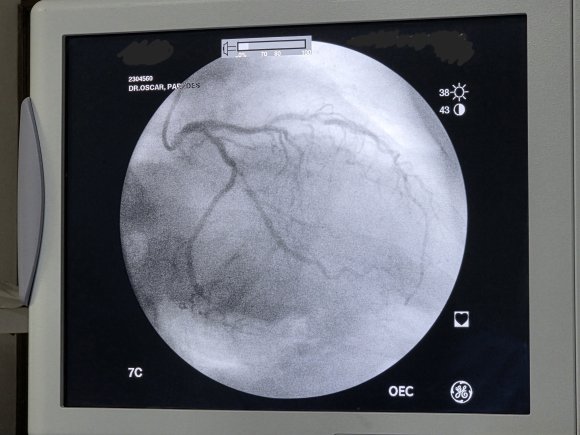 Cateterismo cardiaco izquierdo con varias lesiones