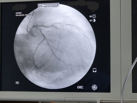 Cateterismo cardiaco con lesiones severas