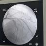 Desendente anterior con varias lesiones severas 