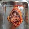 Carcinoma de células renales (cáncer de riñón)