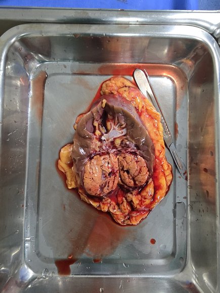 Carcinoma de células renales (cáncer de riñón)