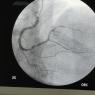 Coronaria derecha con lesion severa