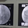Angioplastia coronaria derecha