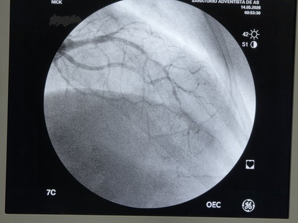 Cateterismo Cardiaco Lesiones DA